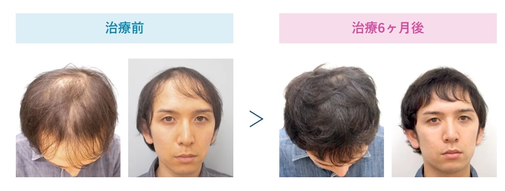 薄毛・AGA ミノキシジルローション皮膚科なら明治通りクリニック 東京 渋谷