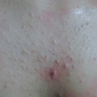 胸ニキビの原因と治し方は？予防法や似た病気との見分け方も解説ハダメディア by BIHADADO.TOKYO