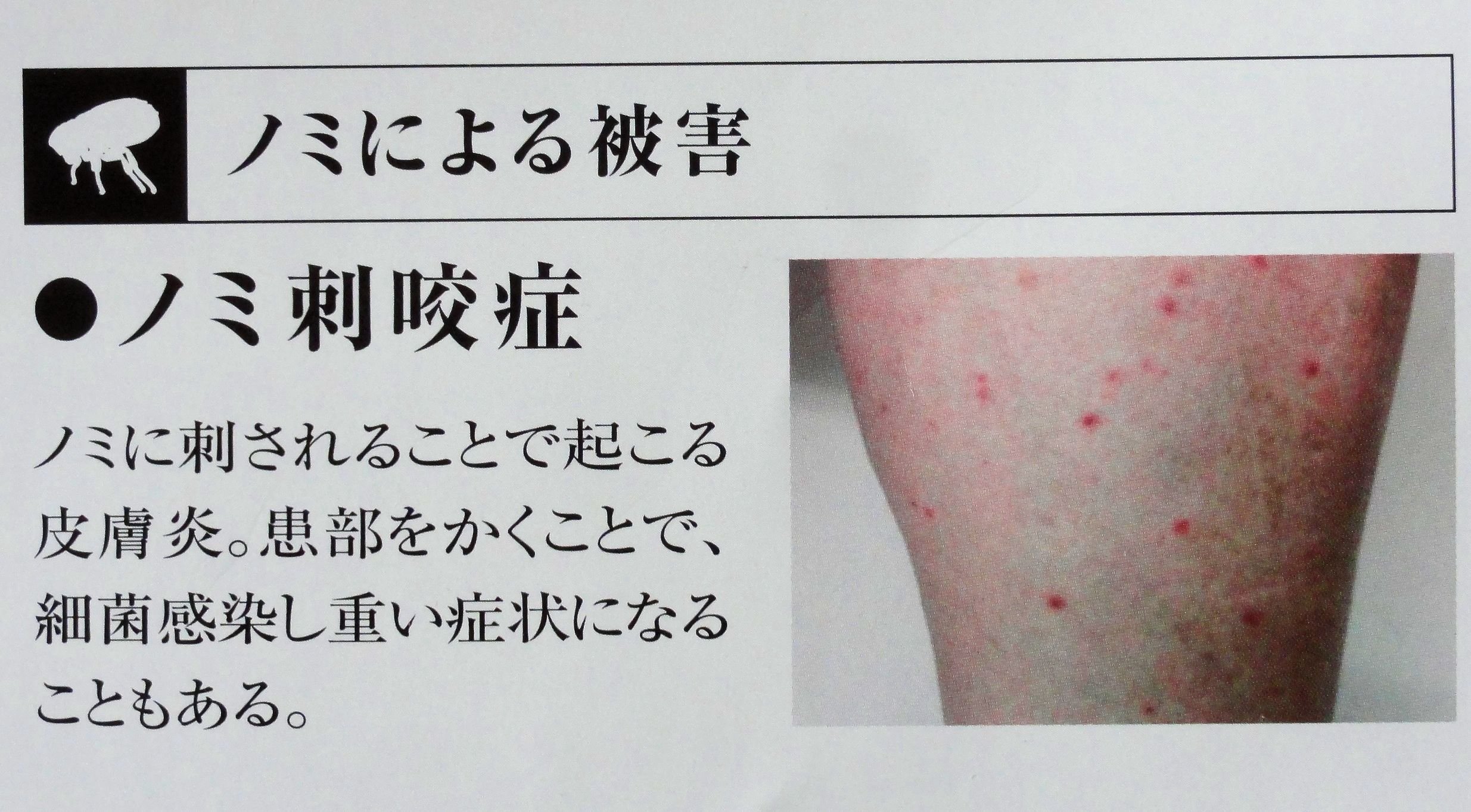 こういうのが足にいっぱいできてびっくりされる方、多いです。 全身にできたらやばい病気ですけど、足にポツポツならたぶんネコノミです。 水ぶくれは放っといても破いても 自分ではやらないでください いいので、それより強いステロイド使うほうが大事で、それより