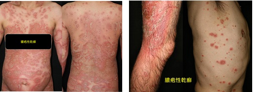 乾癬を公表して“ポジ転” 「もう、見た目にとらわれない」 - Yahoo!ニュース