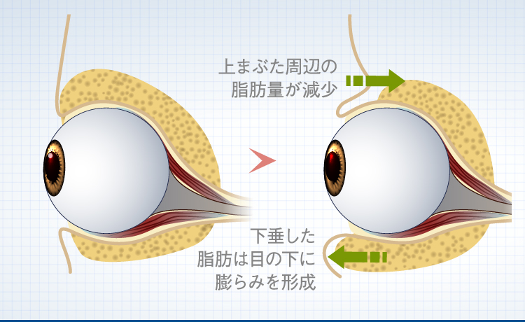 生まれつきの三重まぶたです。きれいな末広二重になりたいです。下- Yahoo!知恵袋