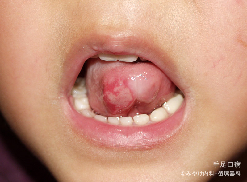 ヘルパンギーナよく見られる子どもの病気 - みやけ内科・循環器科 家庭の医学