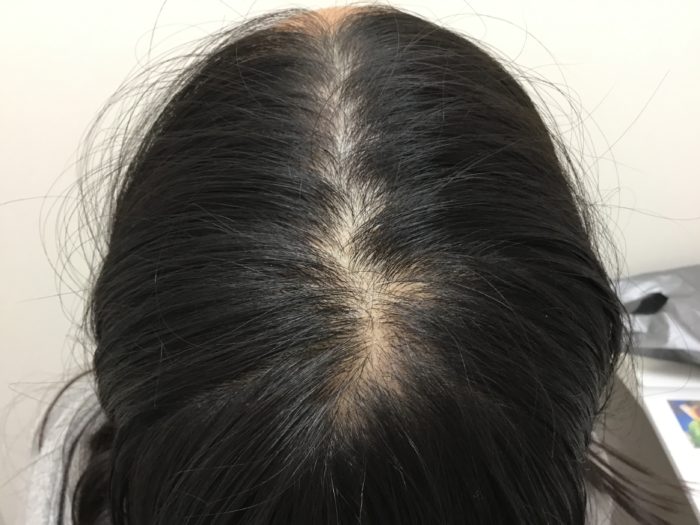 発毛症例 高校生も薄毛改善！！そして目標に向かってファイトー☆彡