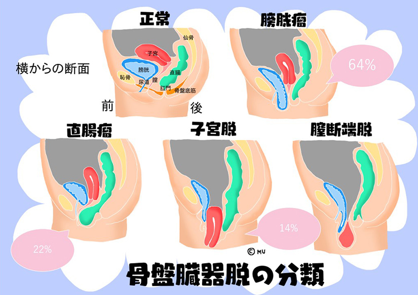 骨盤臓器脱 - 子宮脱治療、膀胱脱治療や直腸脱治療について専門医が説明しますＵｒｏｇｙｎｅネット