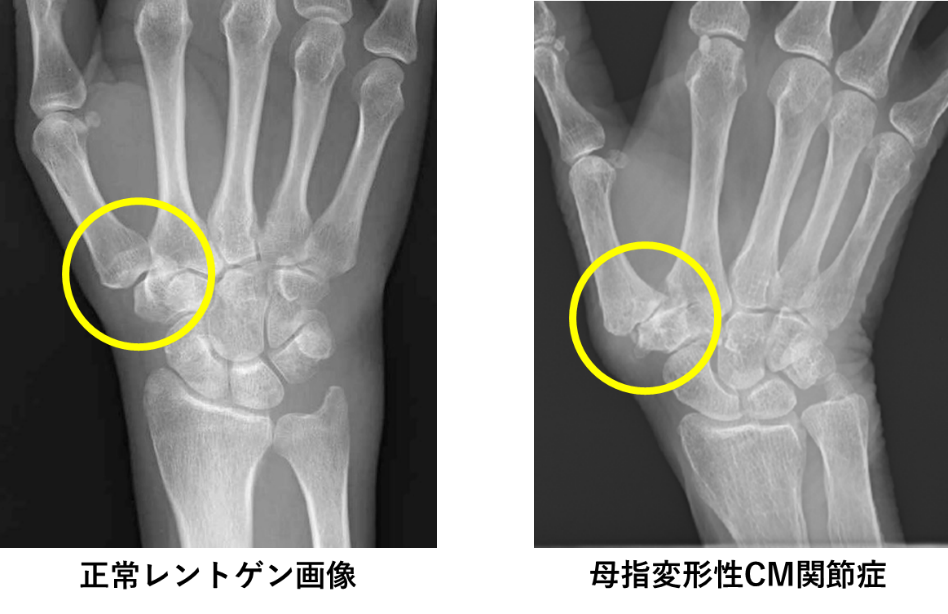 正常な女性の手のレントゲン写真 01808017472 の写真・イラスト素材アマナイメージズ