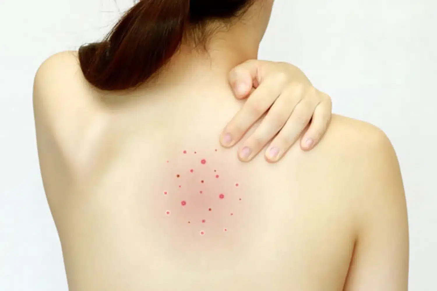 首のニキビの原因とは？場所別の治し方・対策方法などを徹底解説！ナチュラルオーガニックコスメ専門サイト