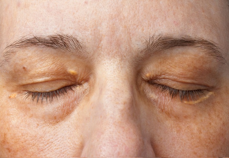 脂質異常症三島市医師会