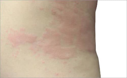 蕁麻疹 じんましん の原因＆対処法薬局・薬店で相談できる皮膚トラブルヒフシルワカル