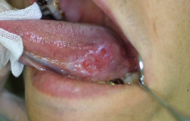 ひび割れた舌のイラスト素材105451846- PIXTA