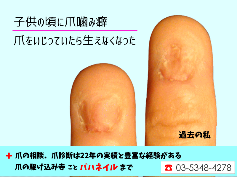 子どもの爪噛み – 「どうして起こるの？」「このままで大丈夫？」に応える当事者の声Branch