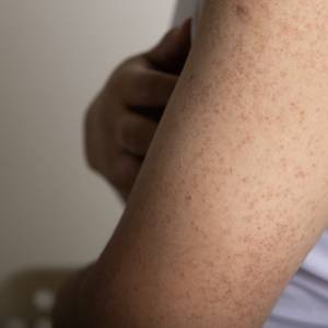 おしりのできもの・ニキビ・湿疹に効果のある市販の塗り薬9選！薬剤師解説– EPARKくすりの窓口コラムヘルスケア情報