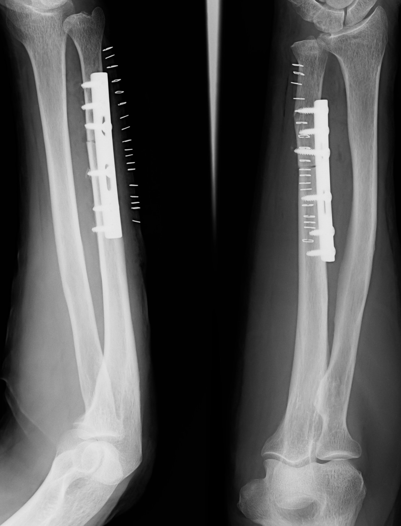 TFCC損傷の原因となる尺骨突き上げ症候群とは