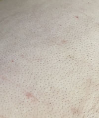 お客様の背中ハーブピーリング2回施術のbefore→afterのお写真です☺️🌿 背中のケアは難しいですよね。 角質も厚く毛穴が詰まりやすくニキビも出来やすい箇所になります。 背中ニキビニキビ跡色素沈着 でお悩みの方は一度ぜひリベルハーブピーリング