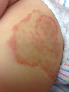 ニキビ、脂漏性皮膚炎にステロイドは厳禁、カビは関係ありません青山ヒフ科クリニック院長Dr.亀山のオフィシャルブログ