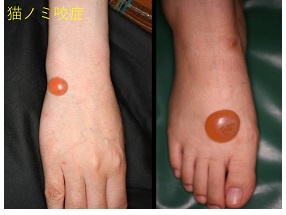 えぬくりブログ: 虫刺症 むしさされ