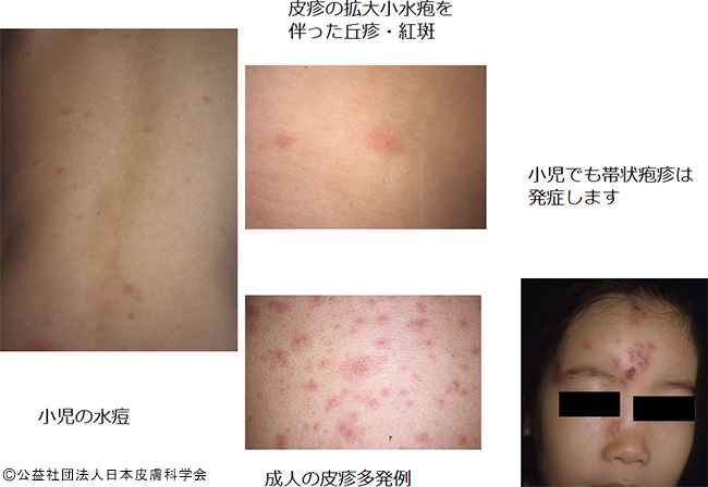 子供のウィルス感染症 Q16 - 皮膚科Q＆A 公益社団法人日本皮膚科学会