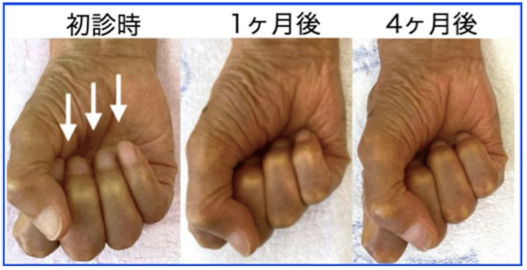 手根管症候群瑠璃光薬局
