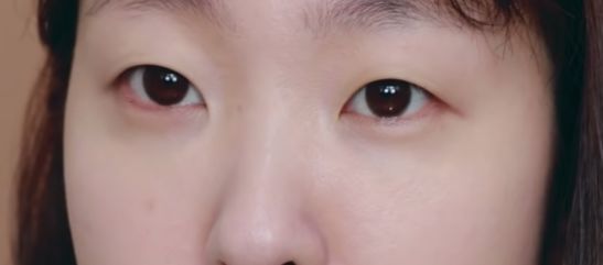 まぶたのたるみ、目の下のクマ、膨らみなど 目もと老化のタイプ別治療法保土ケ谷区タウンニュース