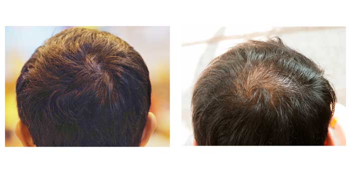 つむじハゲ悩み -高校生です。つむじハゲに悩んでます。友達に指摘されてから-OKWAVE