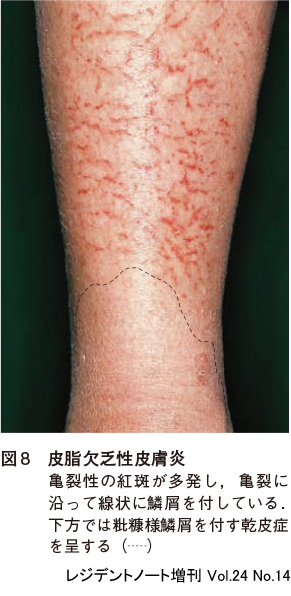 蕁麻疹 じんましん 』の原因・症状・治療法 症例画像 田辺三菱製薬ヒフノコトサイト