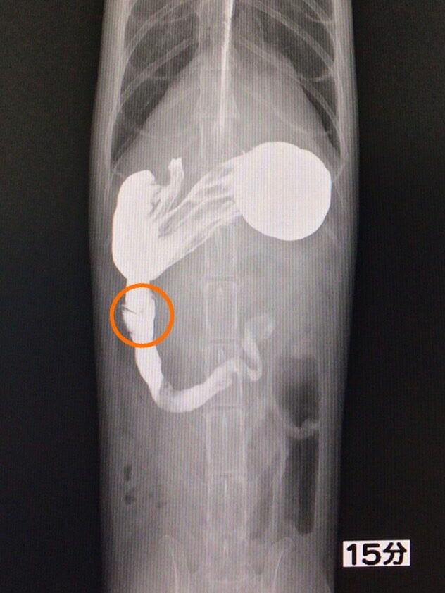 胃がん発見の為の胃カメラ検査の有用性