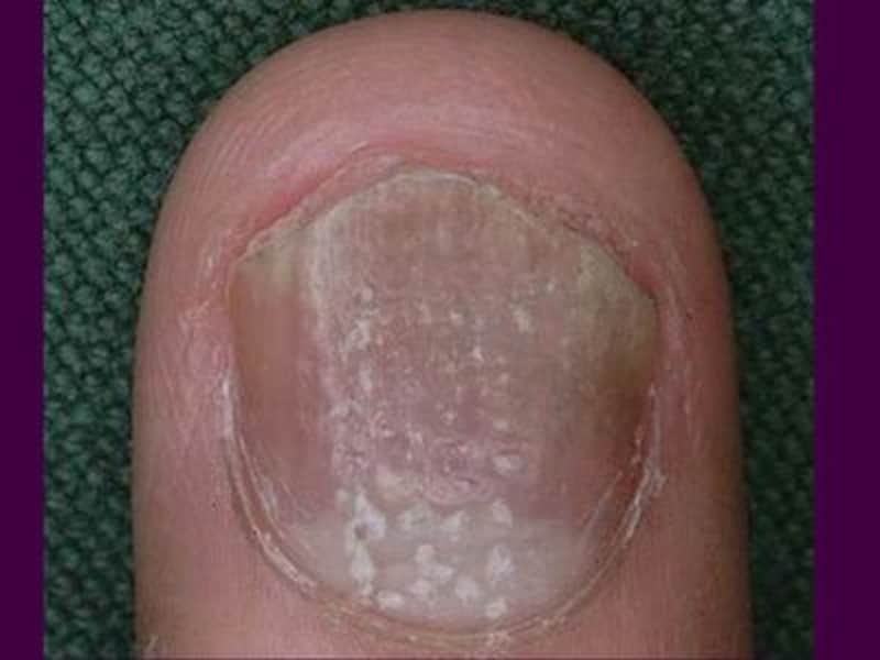 第1回 爪水虫とは。爪が変色・変形していませんか？皮膚科専門医からのメッセージ爪水虫情報サイト