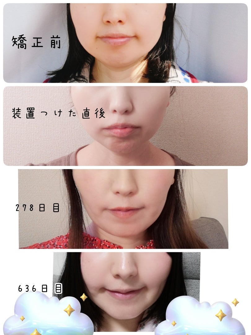 矯正女子の男ウケって？見た目が気になる女性にはマウスピース型矯正装置がおすすめ千代田区秋葉原の矯正歯科・末広町矯正歯科