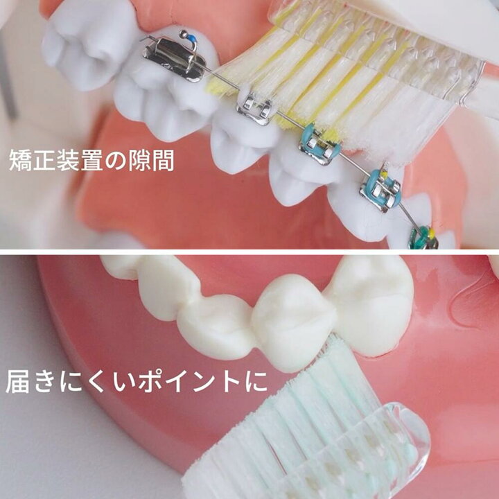 子どもの永久歯が斜めに生えたら？前歯の治療方法や原因を解説アリビオ矯正歯科クリニック