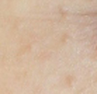 汗疹あせも とは済生会