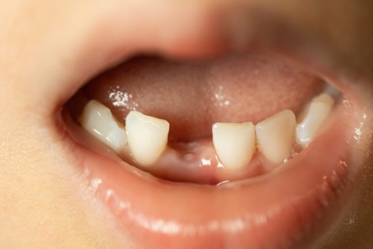 6歳児 前歯の後ろに歯が生えてきたちば歯科医院奥州市水沢 予防歯科予防・メンテナンスに力を入れた歯医者です