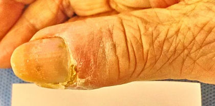 手感染症――化膿性腱鞘炎を中心に │ KANSEN JOURNAL