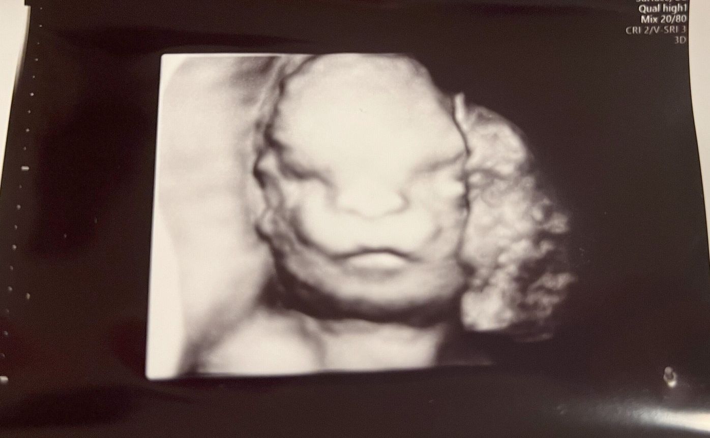 頭部外傷 スポーツ外傷、慢性硬膜下血腫 について