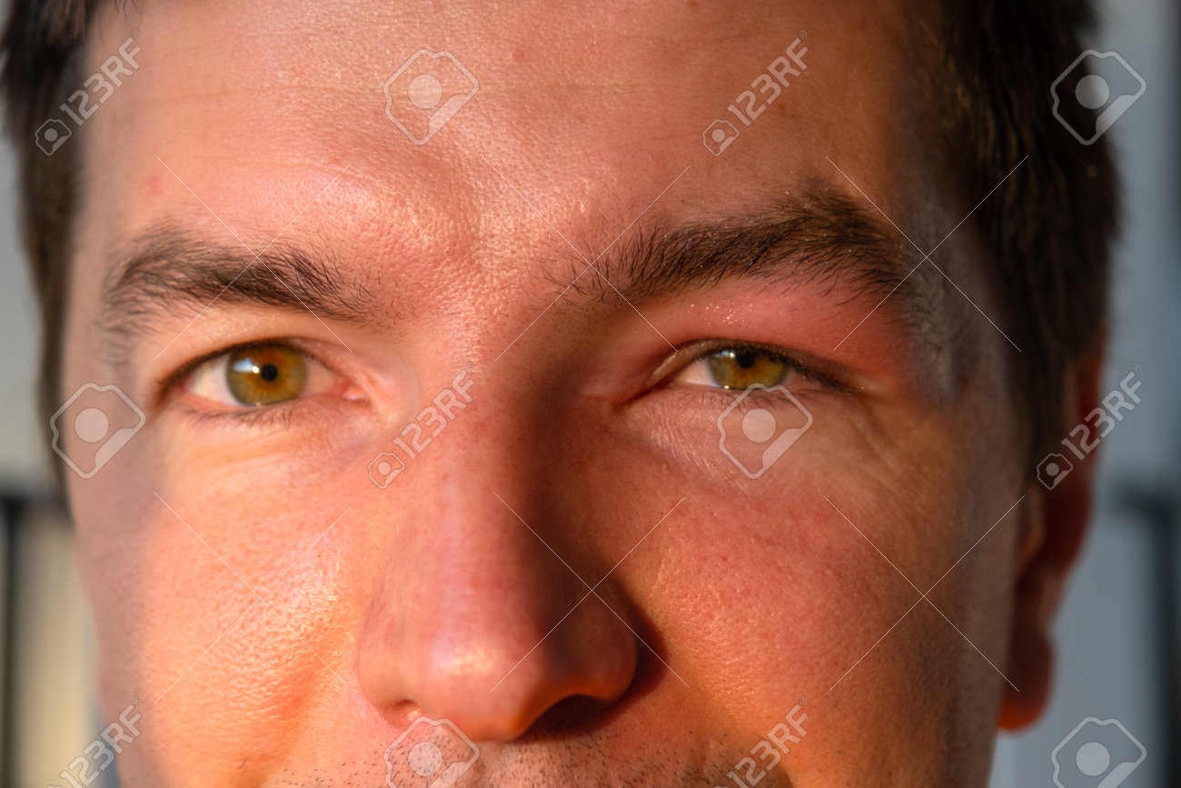 虫刺され 'ブヨ' ～お岩さんも一晩で - 笑顔と健康はキクイモから！ 北丹沢の麓 ＜菊芋＞生産・直販・通販～全国発送