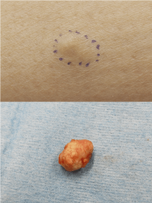 医療従事者監修 陰部 デリケートゾーン のニキビとは？痛い&痒いのはなぜ？原因は性病かもニキビ、ニキビ跡、赤ら顔の改善なら渋谷美容外科クリニック