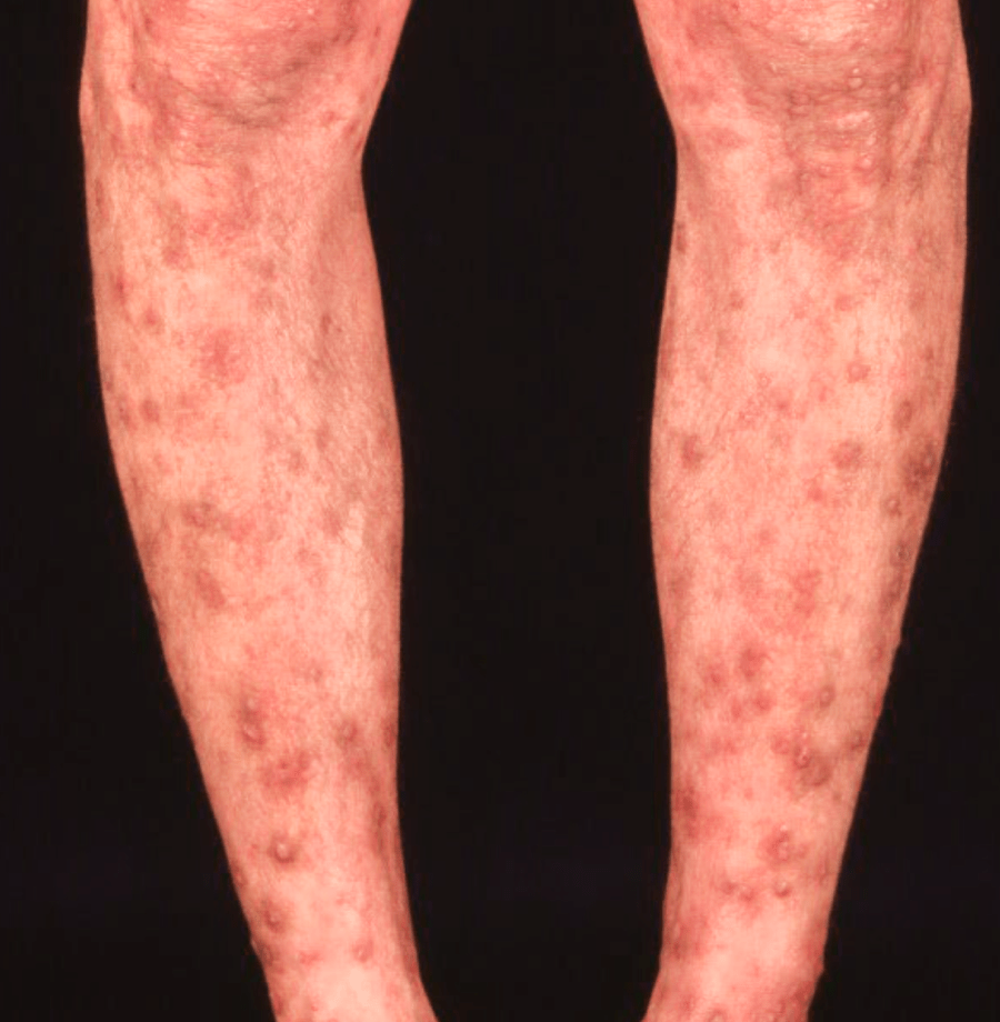 全身に赤いブツブツ 年度がわりは「じんましん」に注意 環境変化、ストレスがきっかけで発症するケースもTBS NEWS DIG3ページ