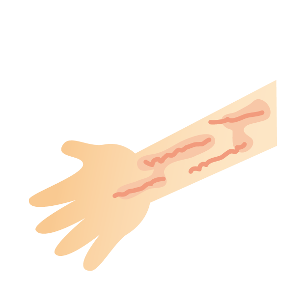 皮膚描画症 を根本から改善したい方 大阪 原因を特定する整体院 医師も推薦する技術とまり木整体院