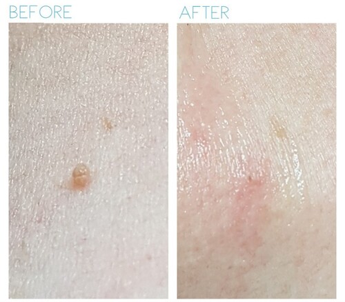 首元のポツポツ、放置して大丈夫？ 首イボの原因と治療法R形成外科皮膚科クリニック