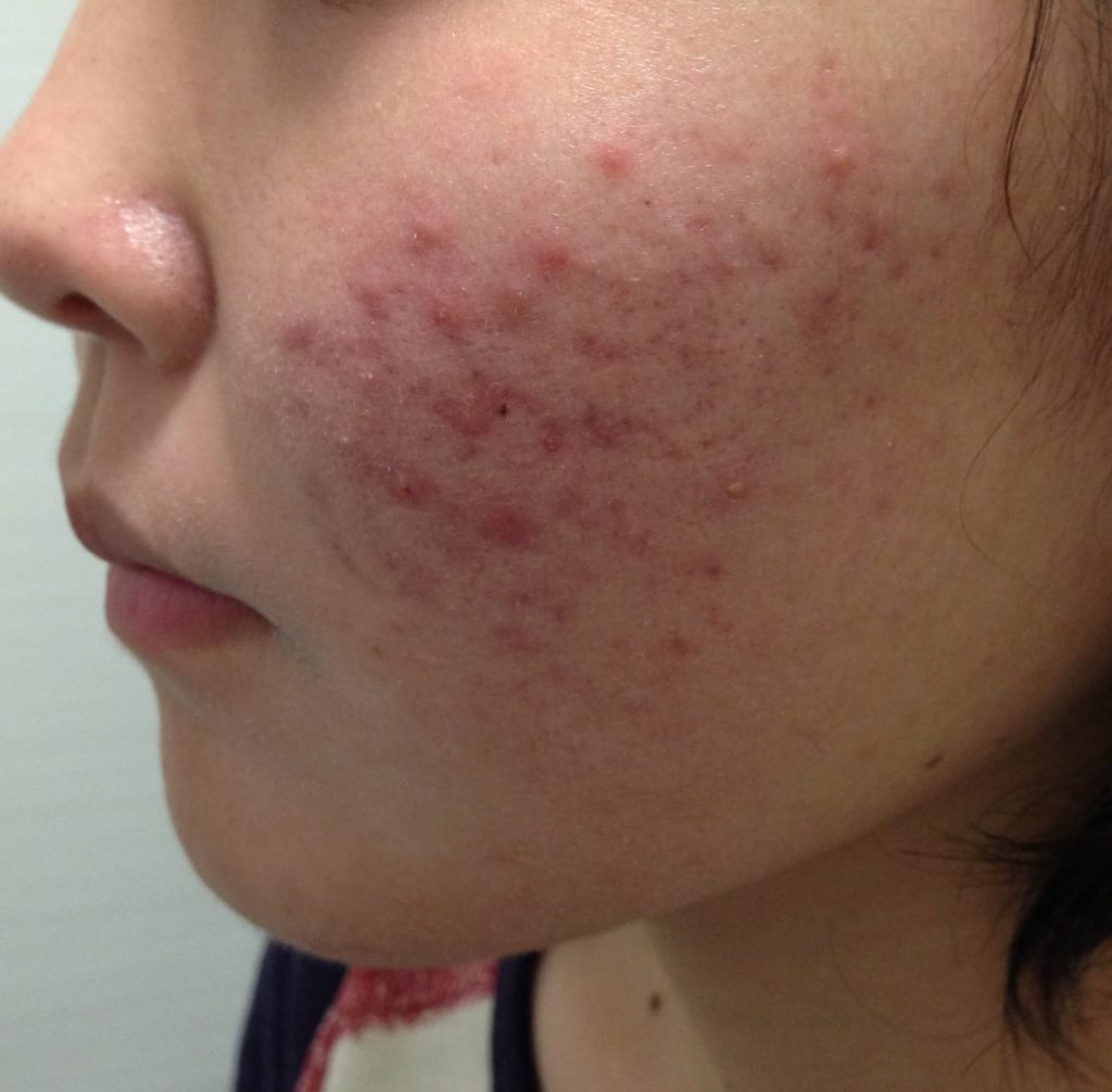 首イボ治療のご相談なら池袋駅前のだ皮膚科へ首、まぶた、わきにできる肌色や茶色のポツポツ アクロコルドン、スキンタグ の症状と治療について