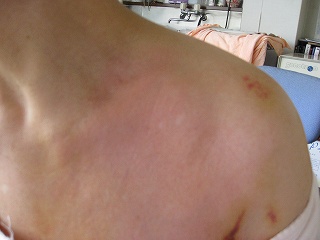 背中・肩の紅斑皮膚トラブルの状態チェックヒフシルワカル