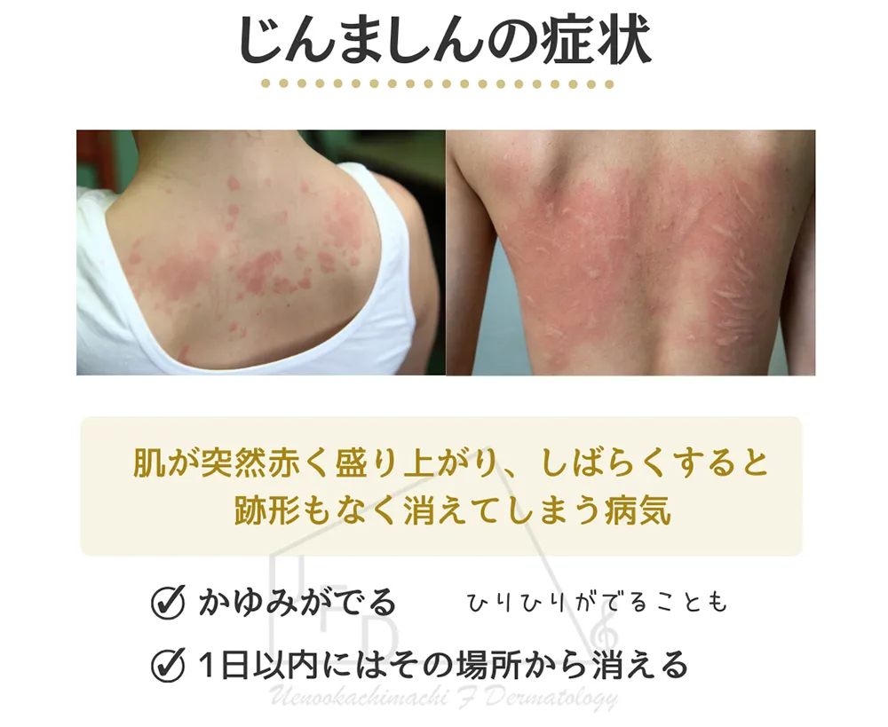 症例写真あり 蕁麻疹の症状・治療法 疲れやストレスが原因のことも皮膚・爪・髪の病気All About