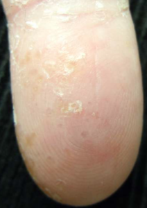 セラピューティック中の反応について☺京都市中京区の皮膚科・美容皮膚科御所南はなこクリニック