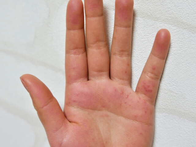 痛くって痒くって・苦しんだ手湿疹がこんなきれいに京都で漢方相談一乗寺グループ