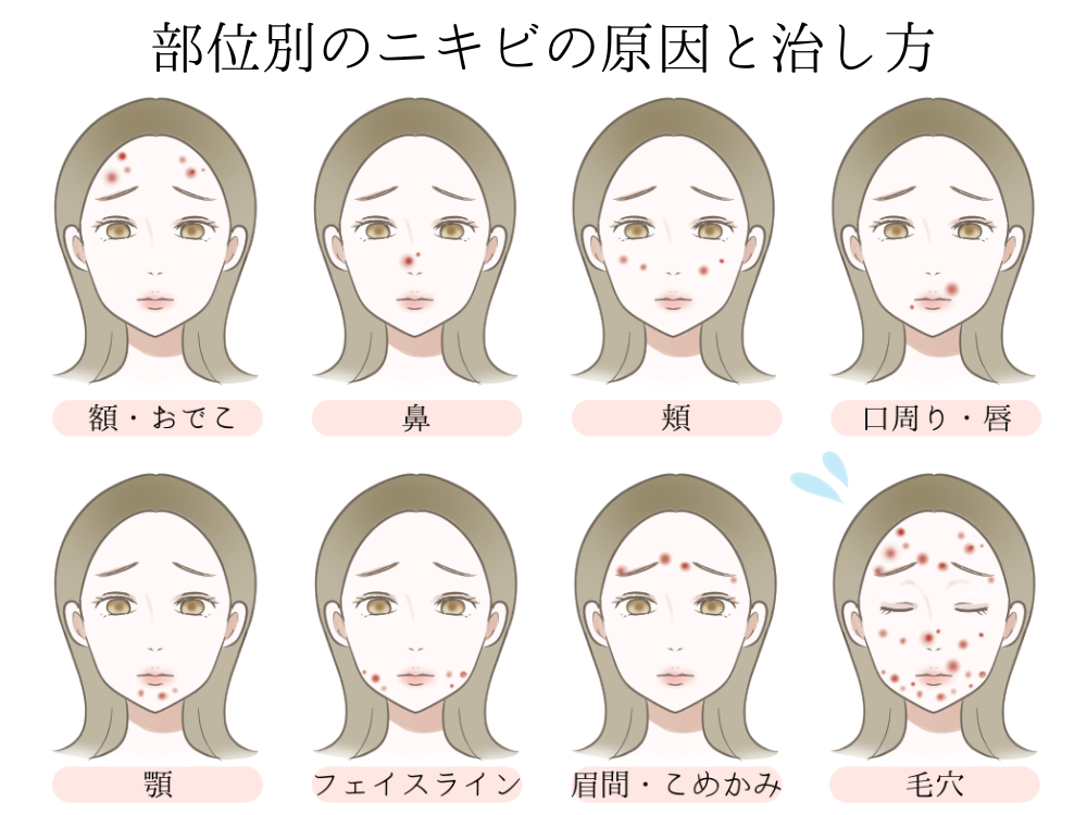 ニキビのできる場所には意味がある！原因と対策を知ろう美容皮膚科タカミクリニック 東京 表参道