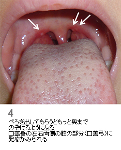 ヘルパンギーナ感染症の症状と対処法 - 茅ヶ崎ファミリークリニック日記