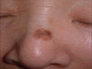 60代男性、手の甲のシミ治療 -Qスイッチルビーレーザーの経過- - 水道橋駅前こばやし皮フ科形成外科