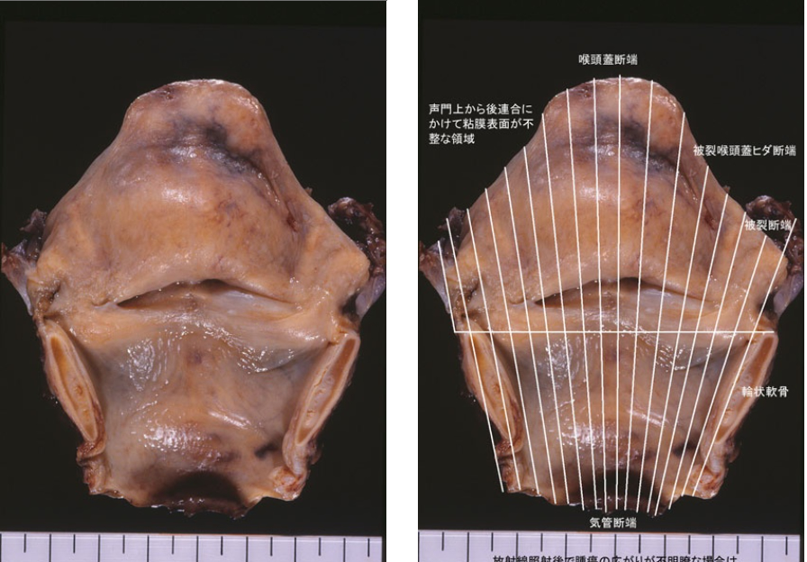 喉頭を構成する4種類の軟骨1. 甲状軟骨 - 喉頭隆起 のど仏 を形成 - 総頚動脈分岐部は甲状軟骨上縁の高さ - 甲状腺は甲状軟骨の前下面 2.輪状軟骨 - 喉頭の土台。輪状軟骨と甲状軟骨、輪状軟骨と1対の披裂軟骨が関節を形成。 - 第6頚椎の高さ - 食道狭窄部 輪状