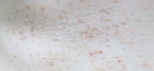 腋臭症粉瘤・ほくろ除去で皮膚科をお探しなら はなふさ皮膚科へ