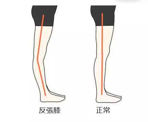 反張膝について 「膝ががくがくする」原因とは！？横浜で鍼灸と言えばオリンピック選手や世界選手権金メダリストも通う土井治療院へ