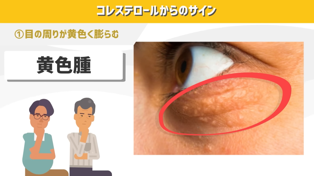 脂質異常症 高脂血症 について江草玄士クリニック