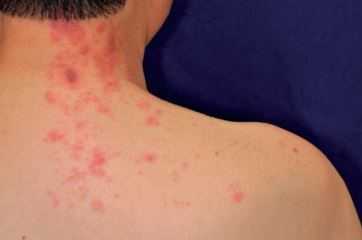 アトピー性皮膚炎の合併症